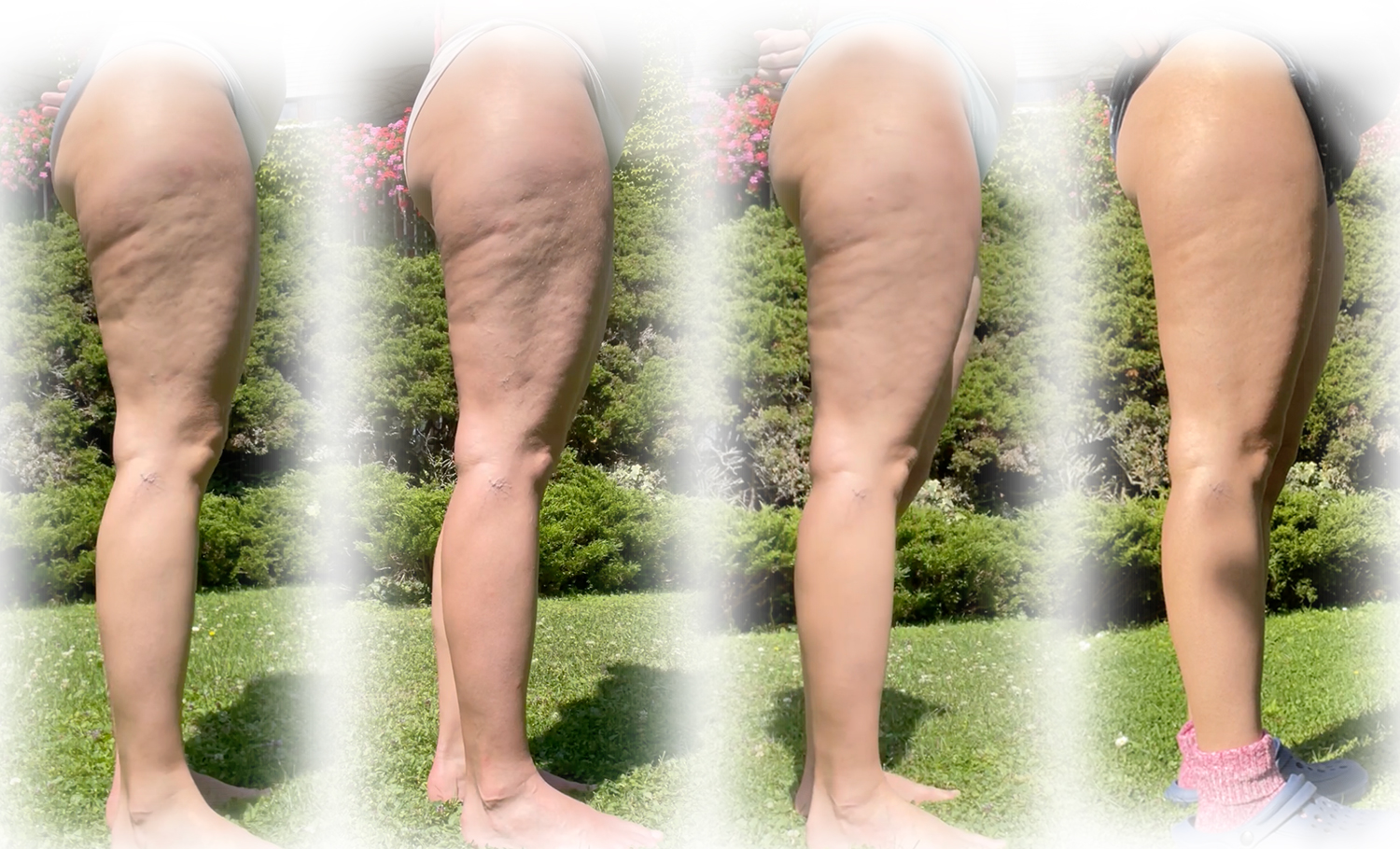 Cellulite loswerden: Vorher-Nachher-Ergebnis meiner Bindegewebspflege